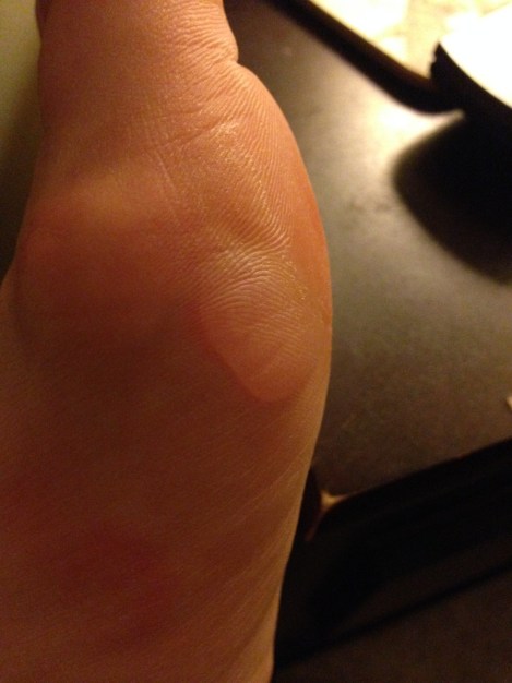 9 Fun with Blisters